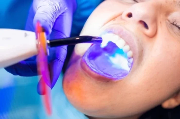 Dental Fillings------0