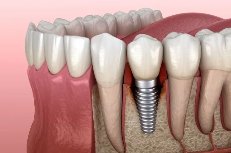 Dental implants ------11