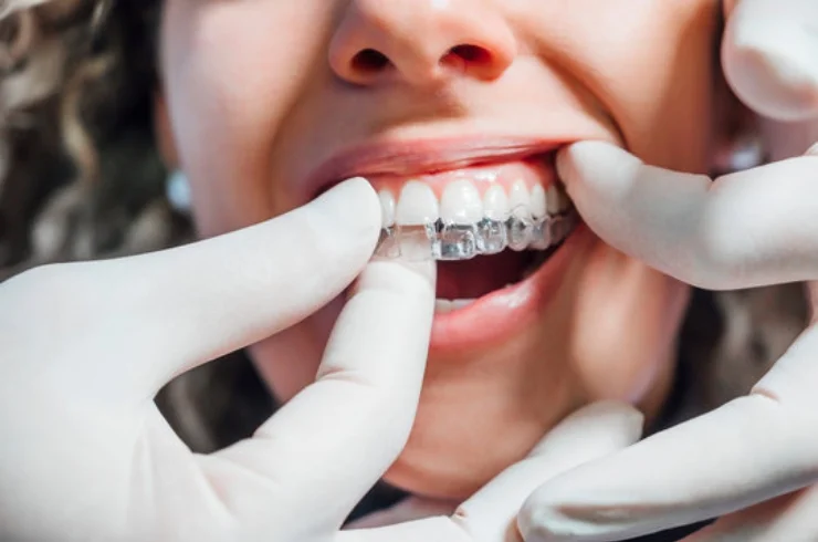 Invisible Aligners