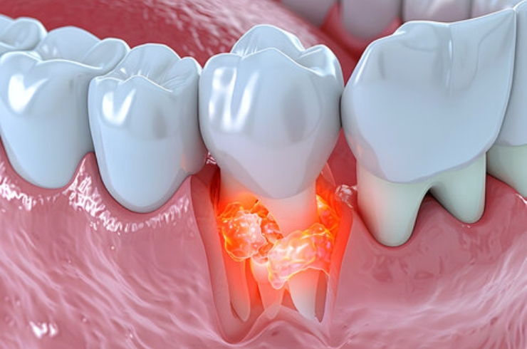 Wisdom teeth